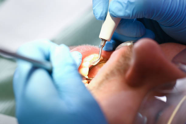 Best Emergency Tooth Extraction in Thomasville, NC